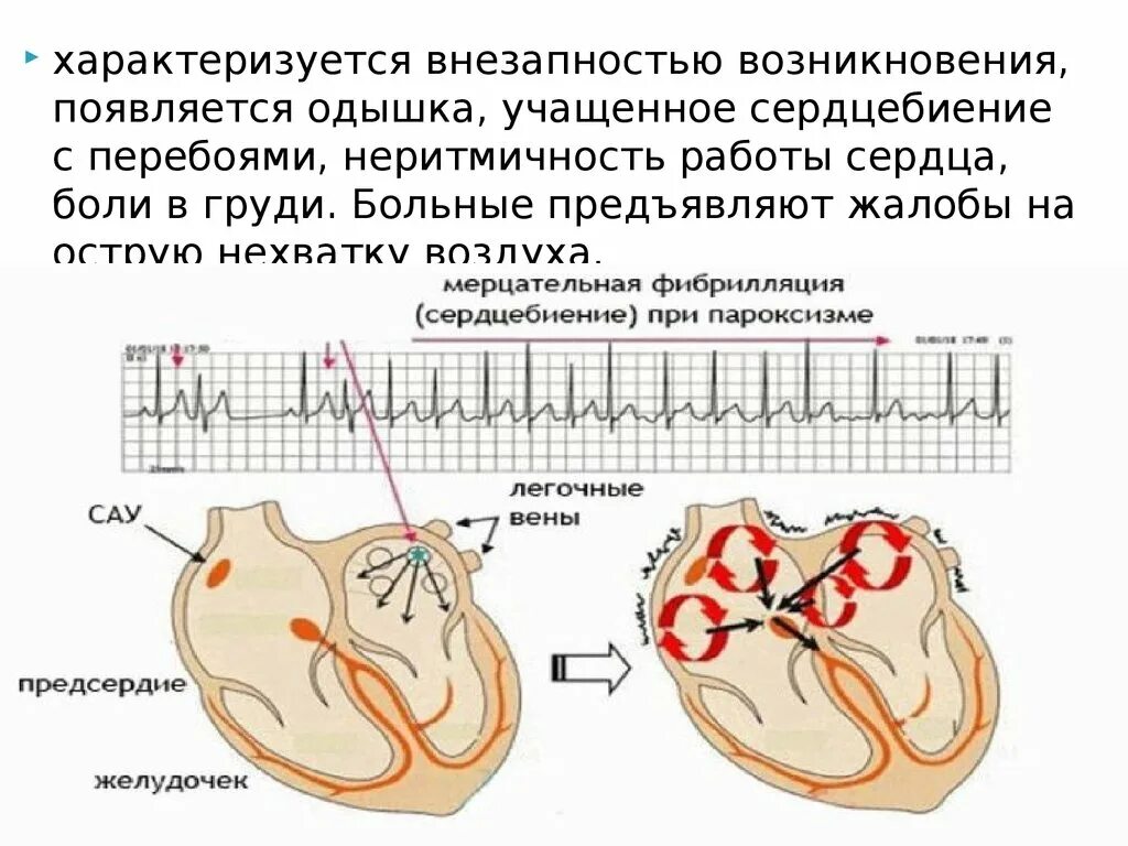 Повышенное давление и тахикардия. Пароксизмальная форма фибрилляции предсердий. Пароксизмальная аритмия. Одышка и сердцебиение. Фибрилляция предсердий схема.