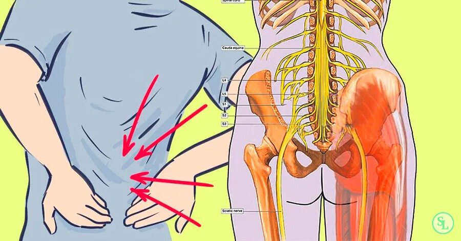 Седалищный нерв позвоночника. Болит спина. Невралгия седалищного нерва. Седалищный нерв схема. И т д симптомы