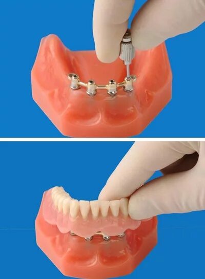 Балочный протез на 4 имплантах. Протез на балочной фиксации на имплантах. Зубной балочный протез на 4 имплантах. Балочная система фиксации на 4х имплантах. Как крепятся съемные