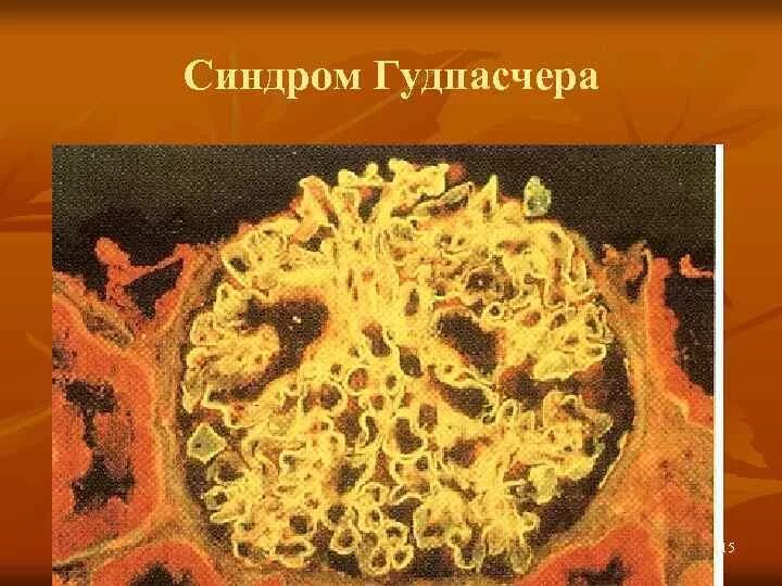 Синдром гудпасчера это. Синдром гудпасчера этиология. синдром гудпасчера патанатомия.