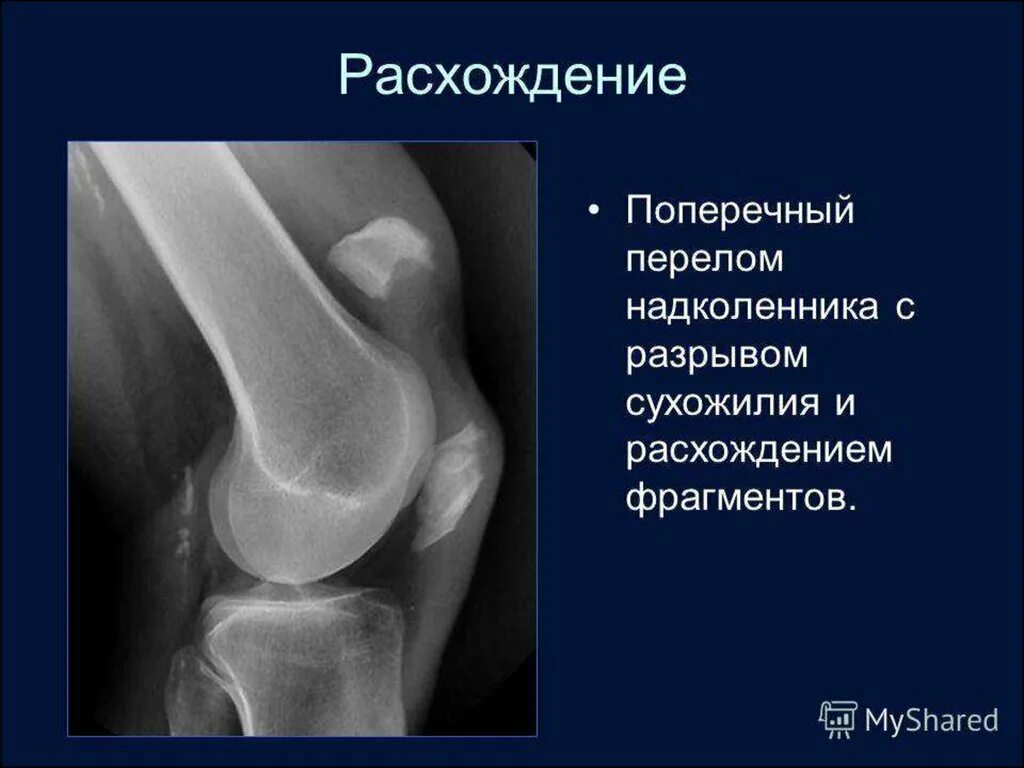 Краевой перелом надколенника. Перелом коленной чашечки рентген. Оскольчатый перелом надколенника рентген. Краевой перелом надколенника рентген.