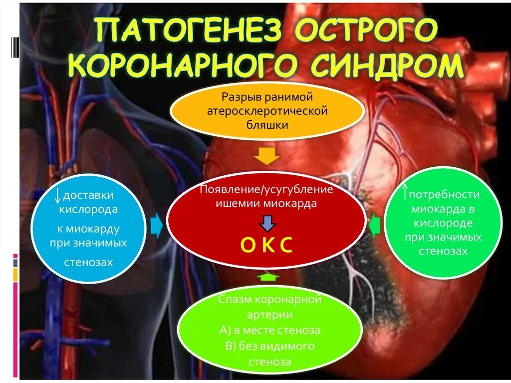 Сайт окс. Синдром острой коронарной недостаточности патогенез. Механизмы развития острого коронарного синдрома. Острый коронарный синдром (Окс). Окс механизм развития.