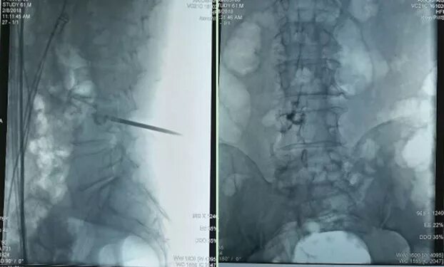 Хондросаркома позвоночника мрт. Метастазы в позвонке l3 и l5. Метастазы в теле позвонка. Остеобластические метастазы позвоночника рентген. Остеобластические метастазы позвоночника на кт.