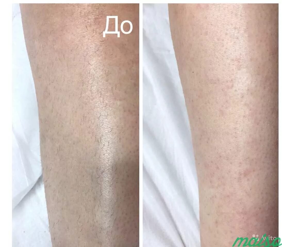 Лазерная депиляция. Лазерная эпиляция до и после. Александритовый лазер эпиляция. Как выглядит после лазерной эпиляции. Электроэпиляция до после первой процедуры.