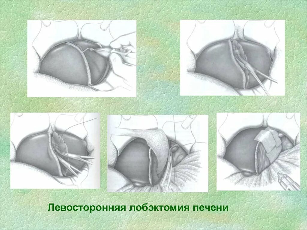 Операция резекция печени. Лобэктомия топографическая анатомия. Левосторонняя резекция печени.