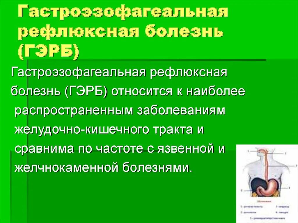 Гастроэзофагеальная болезнь презентация.