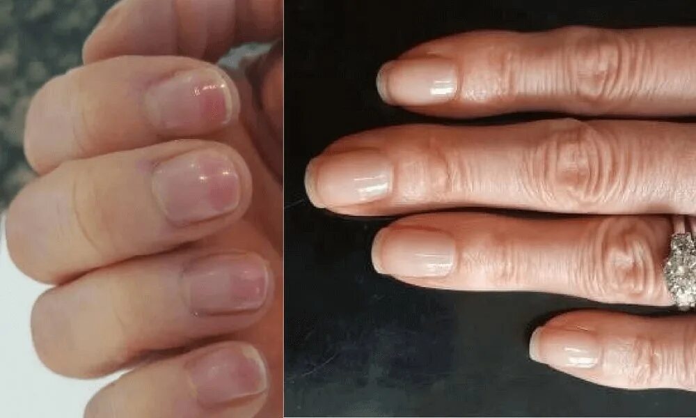 Почему ногти стали мягкими. Тонкие ногти. Ногти после снятия гель лака.