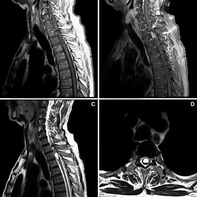 Эпендимома спинного. Эпендимома спинного мозга мрт. Веноспондилография понятно.