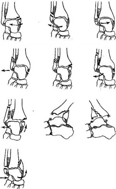 Перелом голеностопного сустава. Пронационно абдукционный перелом лодыжки. Супинационно абдукционный перелом лодыжки. Чрезсиндесмозный перелом наружной лодыжки. Супинационный перелом лодыжки.
