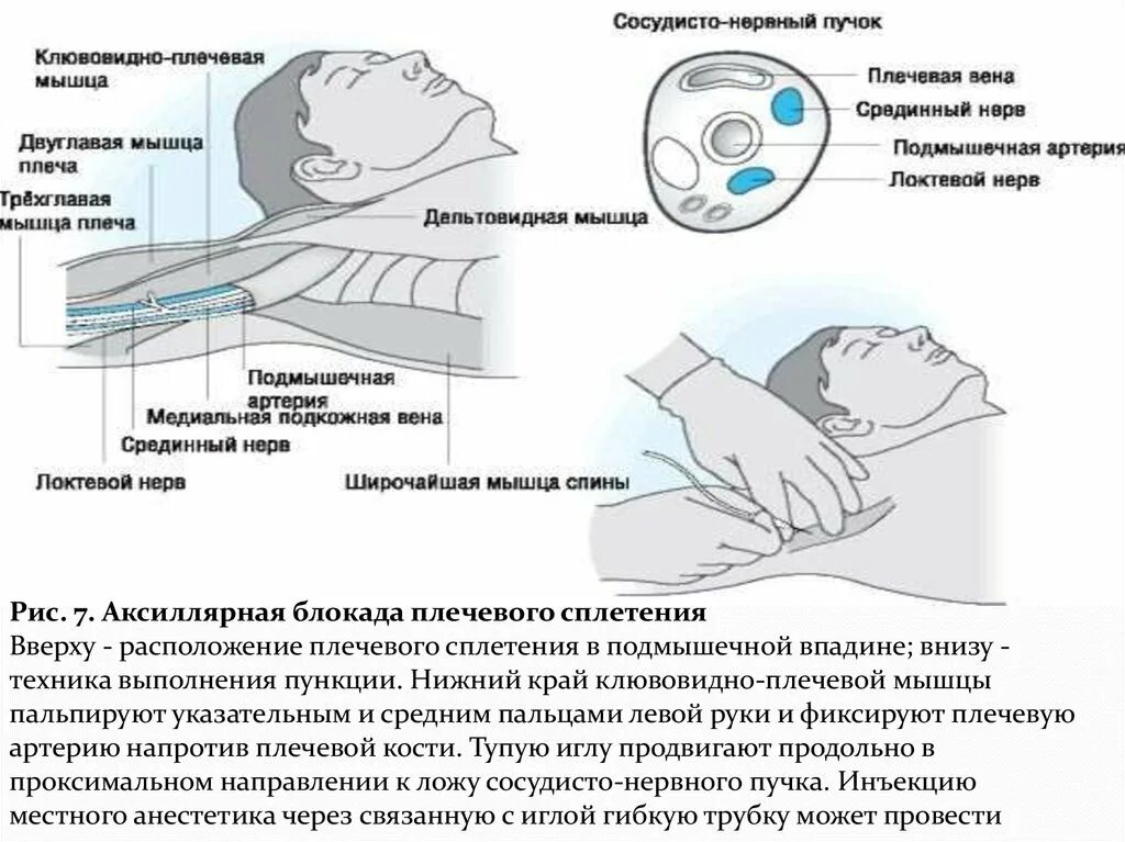 Блокада сплетения. Проводниковая анестезия подмышечным доступом. Проводниковая анестезия подмышечным доступом техника. Аксиллярная блокада под УЗИ. Блокада плечевого сплетения. Техники.