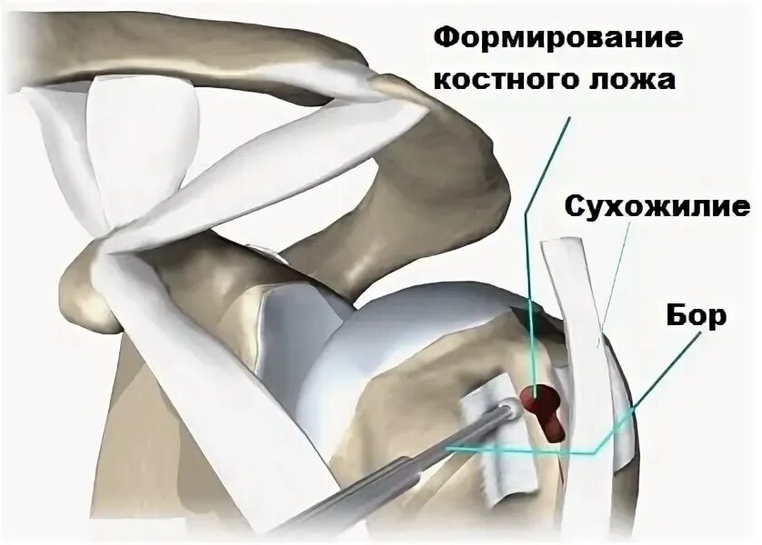 Сухожилие длинной головки двуглавой мышцы. Тенодез сухожилия бицепса. Вывих сухожилия двуглавой мышцы плеча. Сухожилие длинной головки бицепса плеча.