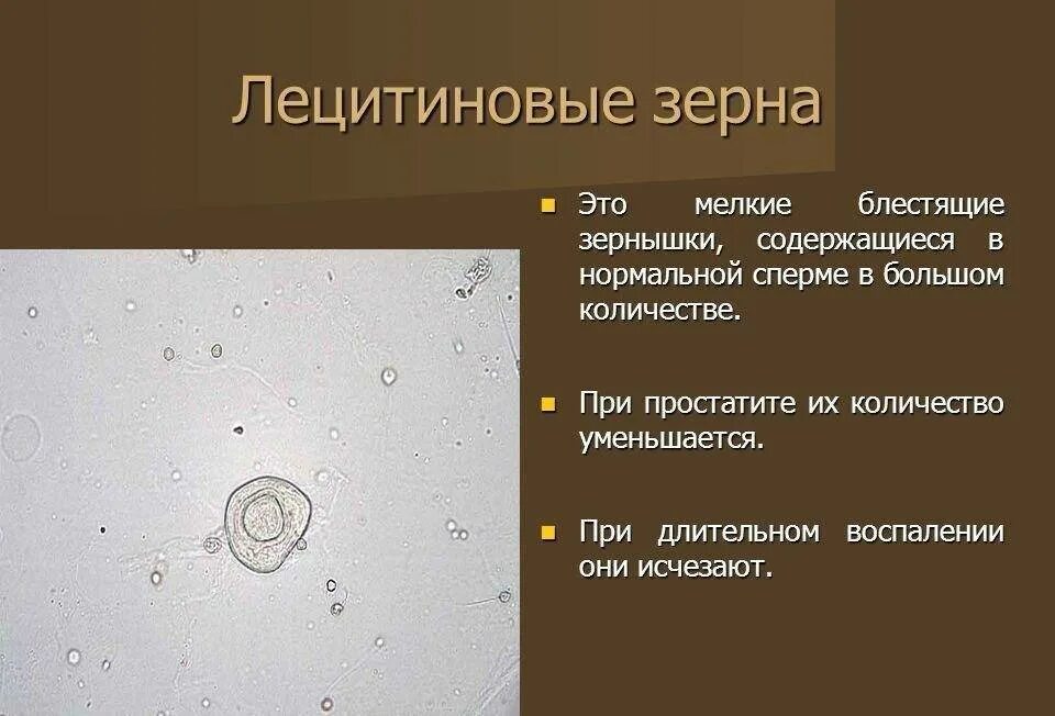 Спермограмма кристаллы спермина. Исследование сока простаты микроскопия. Лецитиновые зерна в спермограмме норма. Лецитиновые зерна в секрете норма. Микроскопическое исследование секрета предстательной железы.