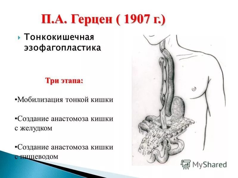 Эзофагопластика пищевода. Операции на ободочной кишке. Мобилизация тонкой кишки. Ушивание ранений тонкой кишки. Мобилизация тонкой кишки.