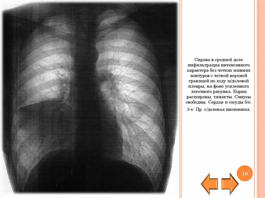 Синусы свободные в легких. Инфильтрация нижней доли справа. Инфильтрация в легком в средней доле. Корень легкого уплотнен что значит
