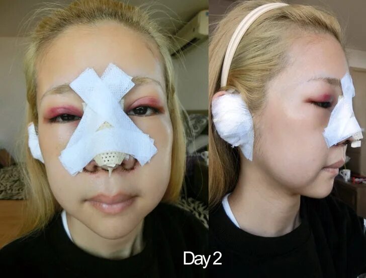 JW Plastic Surgery Part 3 - Recovery: Post Op Day 1 to Day 46 - Центр Пластическ