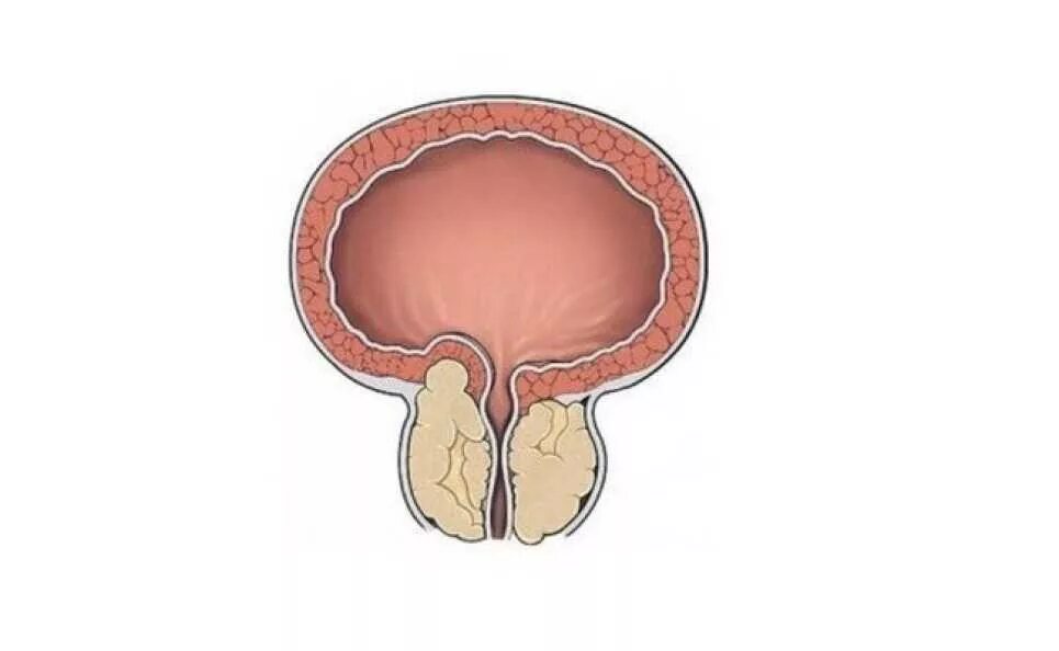 Аденома мочевого пузыря. Мочевой пузырь и простата. Простатит вектор. Простатита гиперплазии предстательной железы