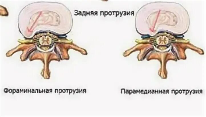 Медианно парамедианная билатеральная. Левосторонняя парамедианная протрузия. Левосторонняя парамедианная протрузия диска. Центрально парамедианная протрузия. Парамедианная протрузия диска.