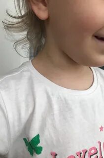 Темная шея у ребенка
