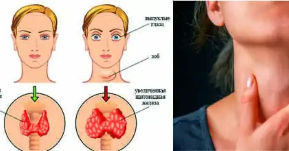 Расширенная щитовидка. Опухлость щитовидной железы. Щитовидная железа в горле.