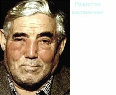 Прогноз рожи