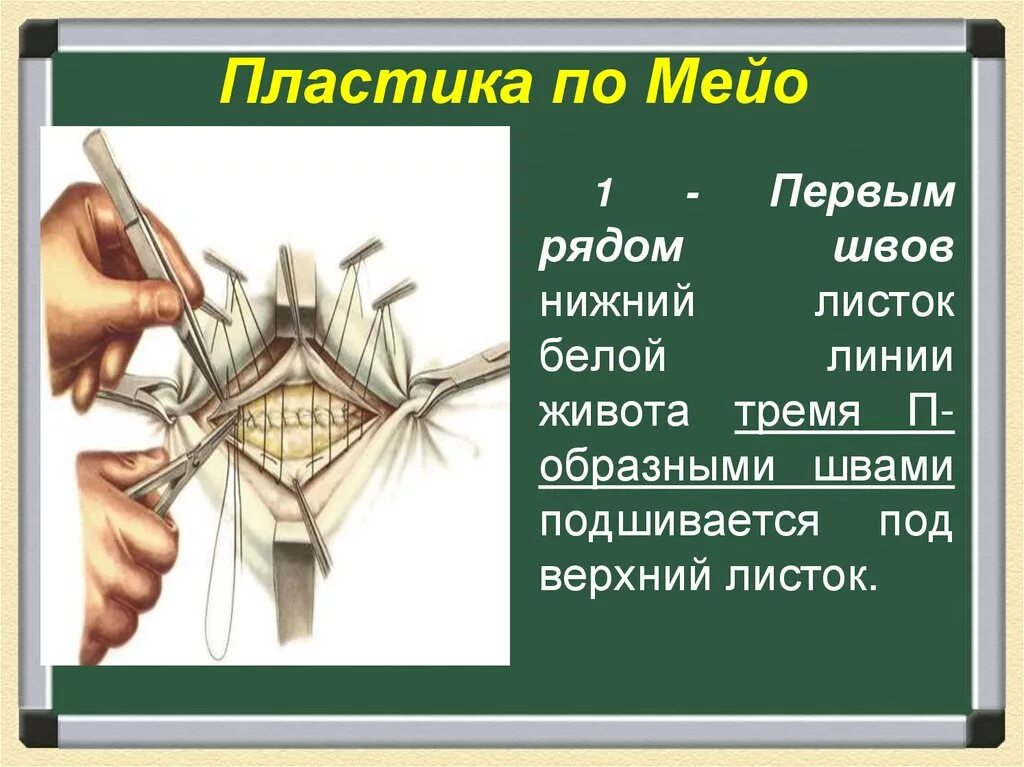 Постемпскому грыжесечение. Пластика по филатову филатовский стебель. Пластика по мейо и сапежко. Пластика по другому. Пластика по другому.