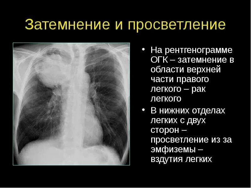 Затемнение верхней доли легкого. Эмфизема лёгких рентгенограмма описание. Эмфизема лёгких рентгенограмма просветление. Затемнение на рентгенограмме легкого. Рентген затемнение доли легкого.