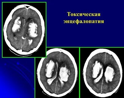 Токсическая энцефалопатия