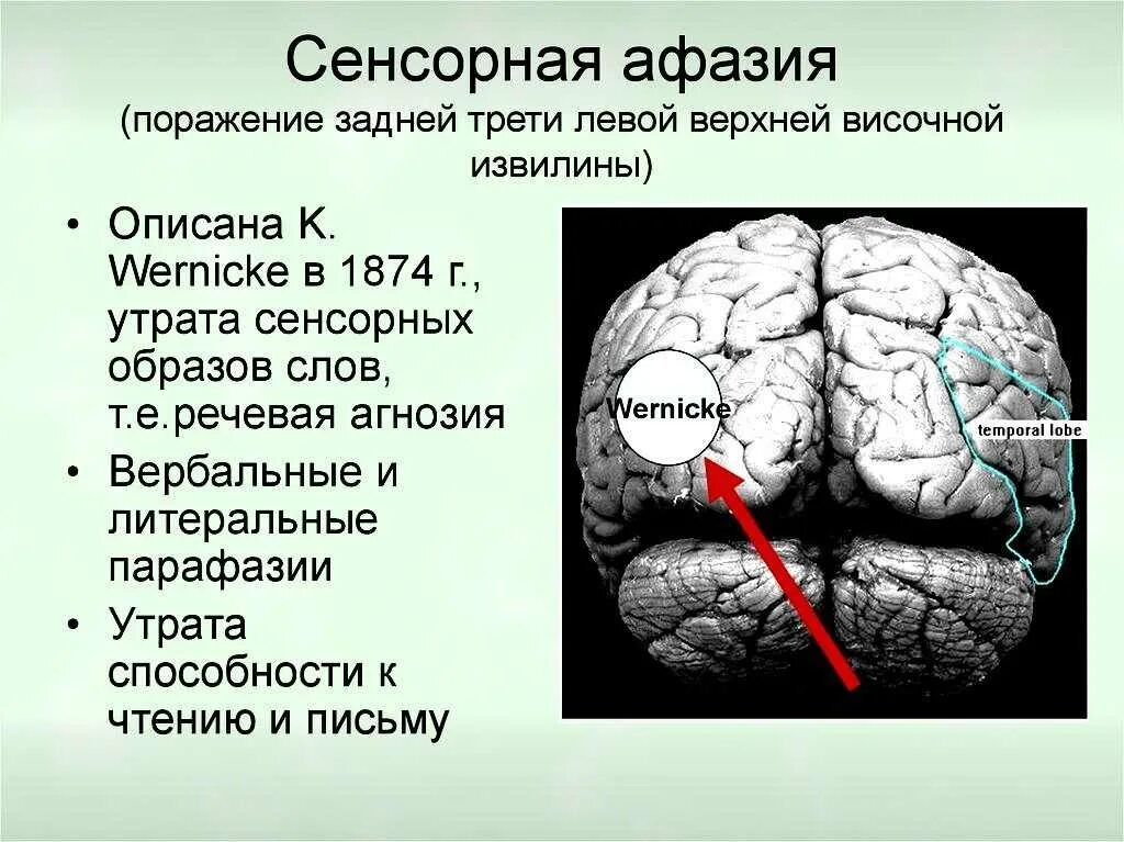 Зона Брока и Вернике афазия. Афазия сенсорная моторная динамическая. Моторная афазия сенсорная афазия амнестическая. Задняя треть верхней височной извилины. Расстройство полушарий