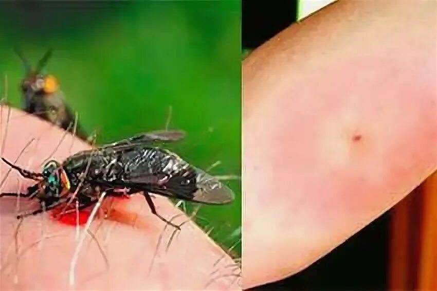 Чем снять отек от укуса мошки на ноге у ребенка