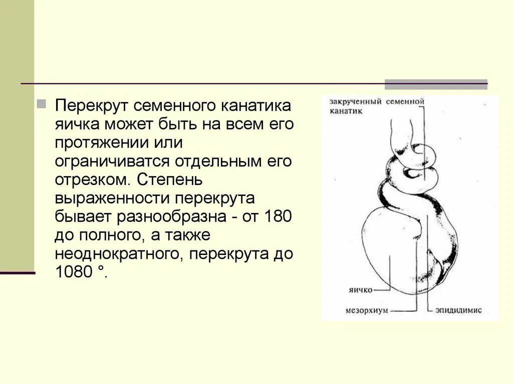 Болит правое яйцо у мужчин причина. Перекрут семенного канатика. Семенной канатик перекрутился симптомы. Перекрут канатика яичка. Заворот яичка (перекрут семенного канатика).