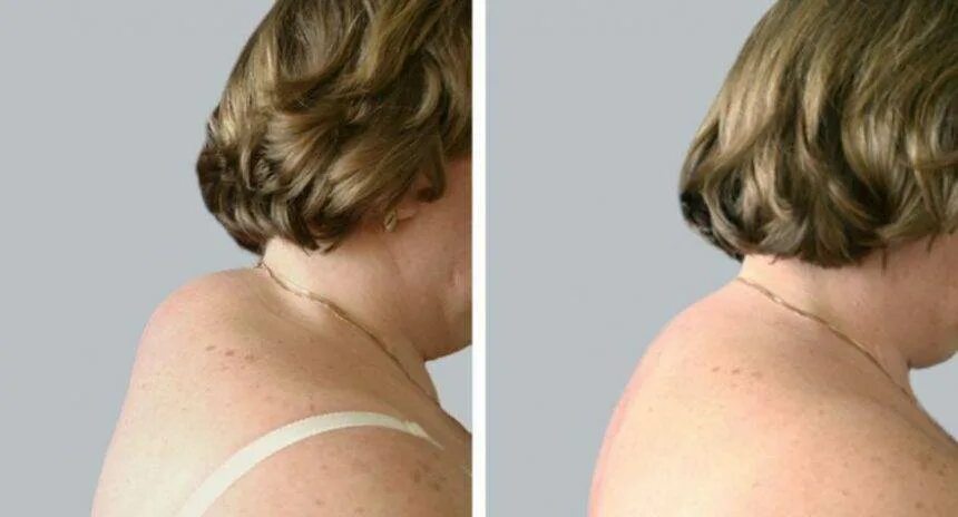 Удаление горба. Удаление горба. Удаление горба. Удаление горба. Удаление горба.