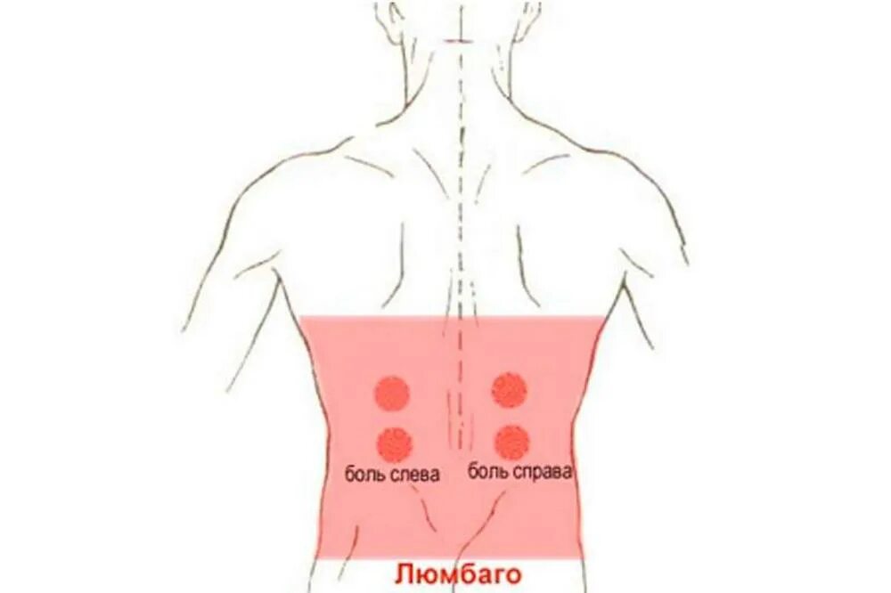 Люмбаго. Болит спина слева. Простреливающая боль в спине. Люмбаго в пояснице. Боли при повороте туловища