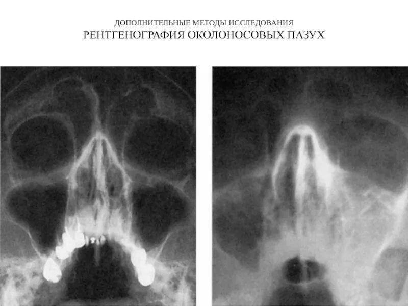 Верхнечелюстной синусит рентген. Левосторонний фронтит рентген. Двухсторонний верхнечелюстной синусит рентген. Одонтогенный верхнечелюстной синусит рентген. Пристеночный отек слизистой