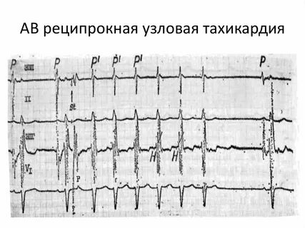 Узловая тахикардия