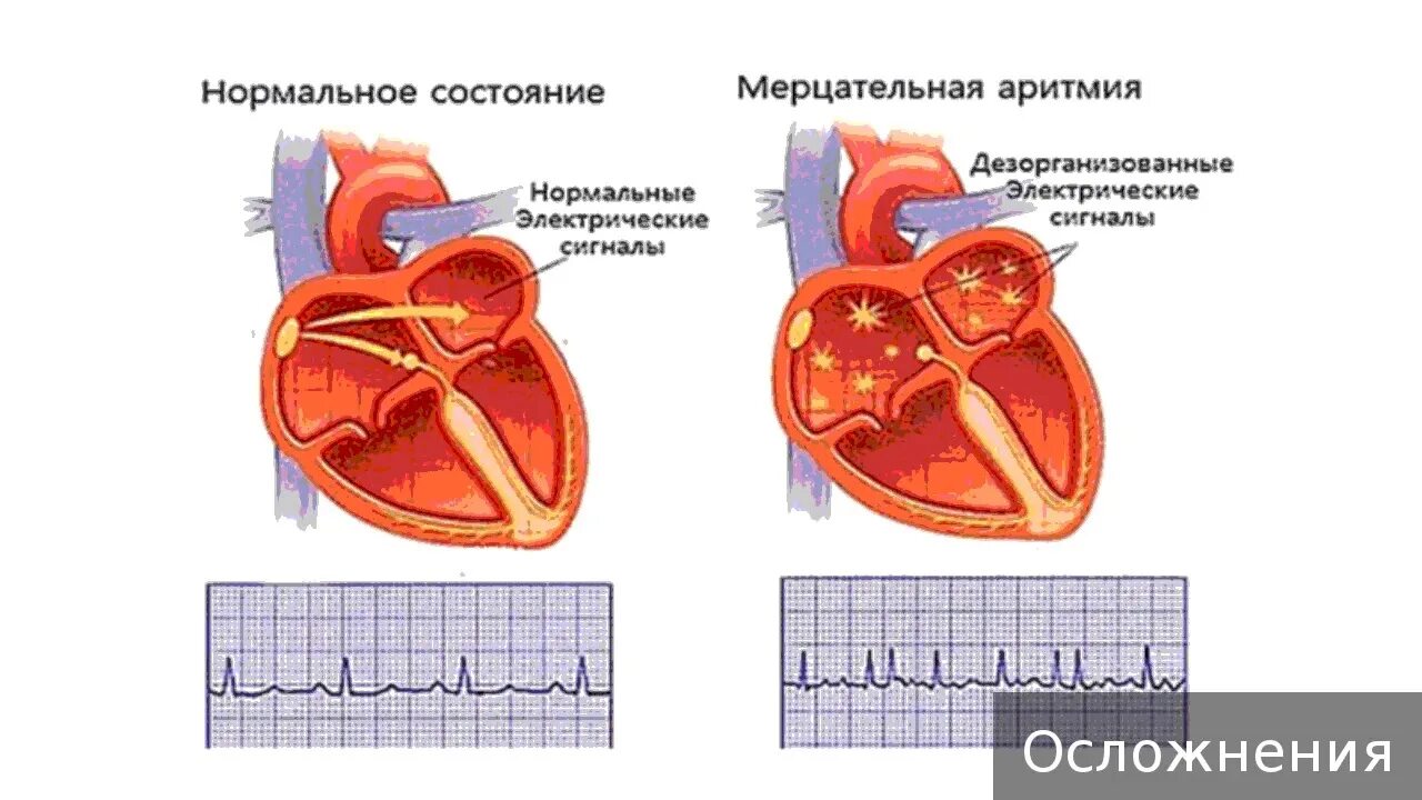 Аритмия сердца. Синусовая аритмия на экг. Незначительная аритмия. Критерии аритмии. Незначительная аритмия.