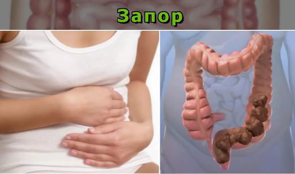 Запор.