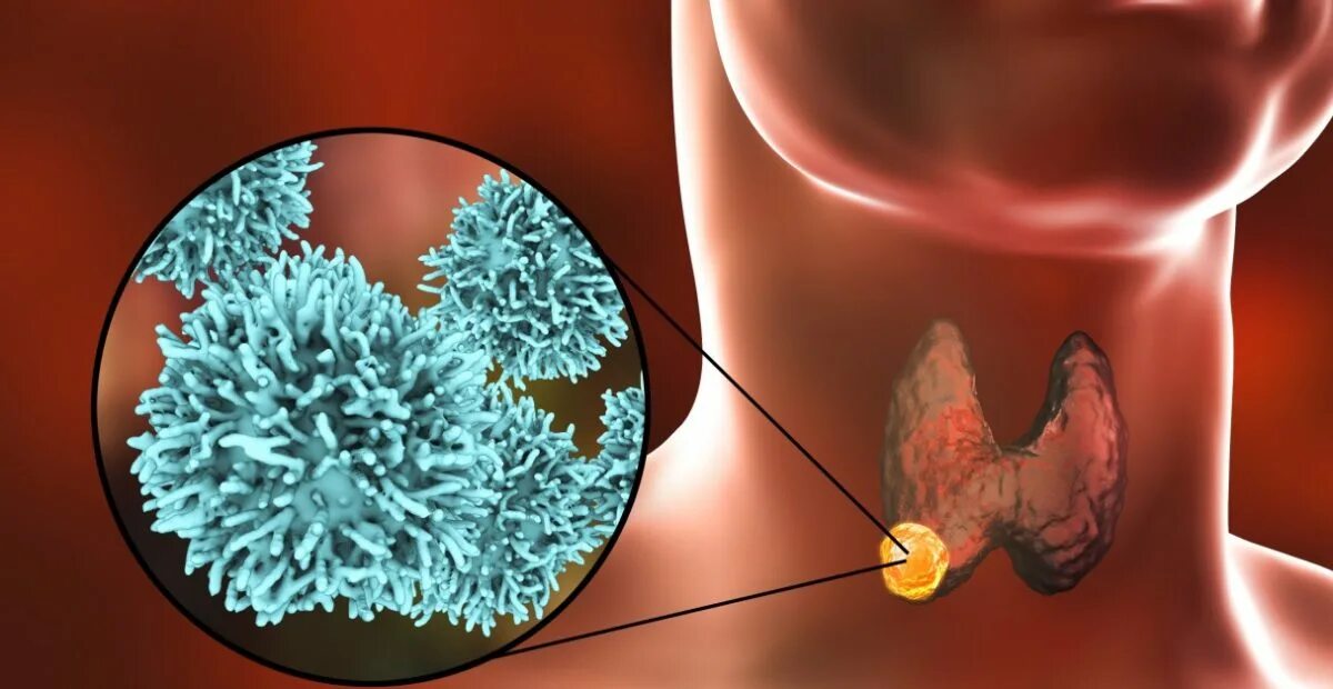 Опухоль щитовидной железы. Предраковое щитовидки. Новообразование в щитовидной железе. Припухлость щитовидки. Папиллярный рак после операции