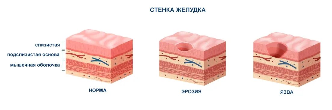 Слизистые покровы или гладкая поверхность мелкие размеры. Стадии рубцевания язвы желудка.