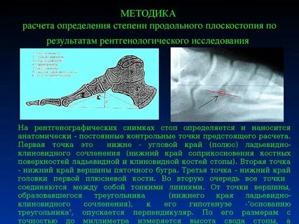 Плоскостопие рентген измерение