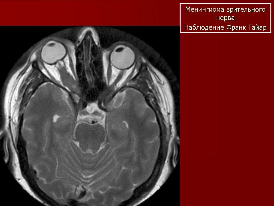 Глиома зрительного нерва мрт. Невринома зрительного нерва мрт. Менингиома зрительного нерва мрт. Ретробульбарный абсцесс кт.