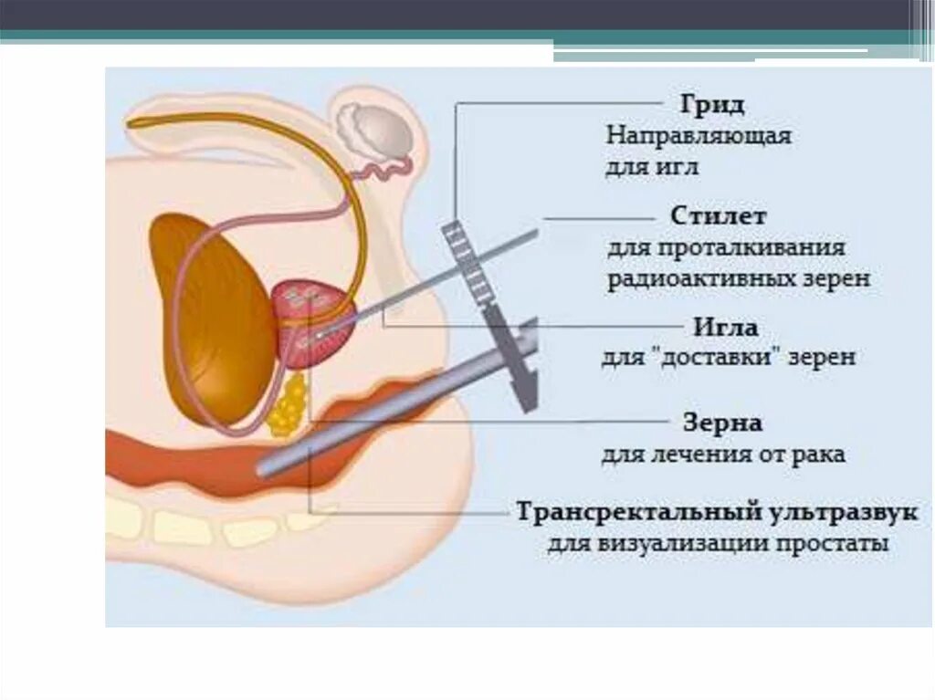 Предстательная железа капсула. Криоабляция предстательной железы. Брахитерапия предстательной. План брахитерапии предстательной железы.