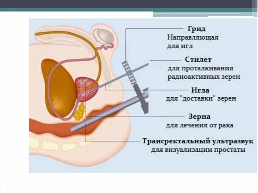 Капсула предстательной железы. Криоабляция предстательной железы. Брахитерапия предстательной. План брахитерапии предстательной железы.