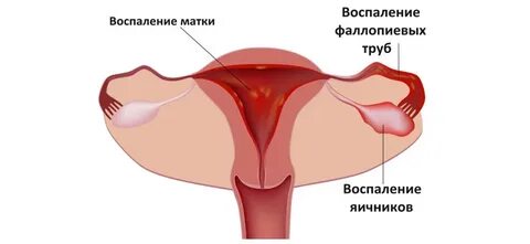 Гнойные придатки