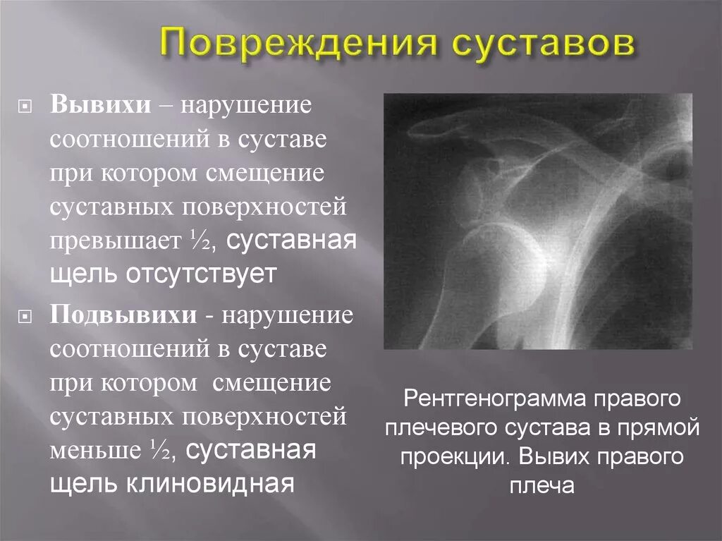 Вывих сустава описание