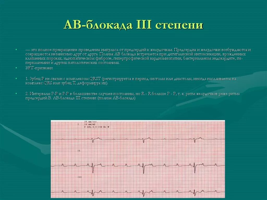 Полная атриовентрикулярная блокада 3 степени на ЭКГ. АВ блокада 3 на ЭКГ. А-В блокада 3 степени на ЭКГ характеризуется. Полная АВ блокада 3 степени ЭКГ. Fuller av