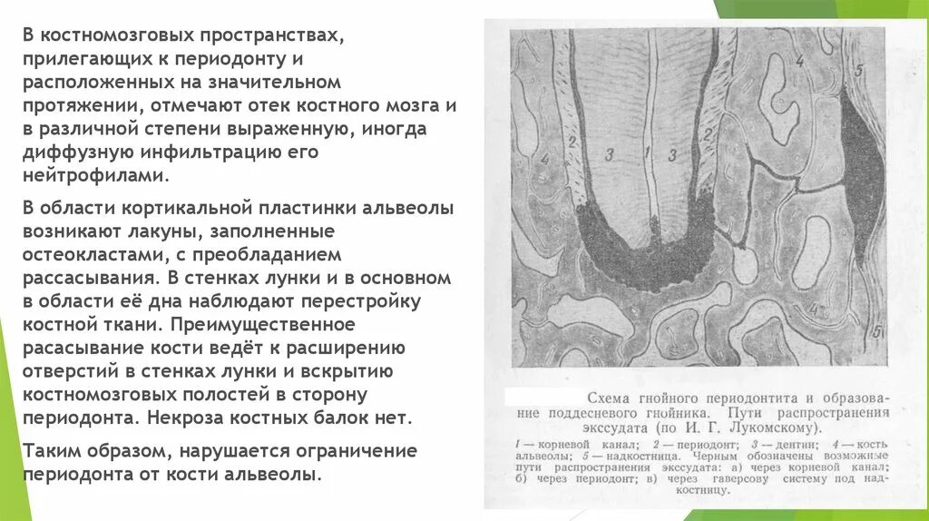 Отток экссудата. Пути распространения экссудата при остром периодонтите. пути распространения гнойного экссудата из периодонта.. пути оттока экссудата из периодонта. пути распространения гнойного экссудата при остром периодонтите.
