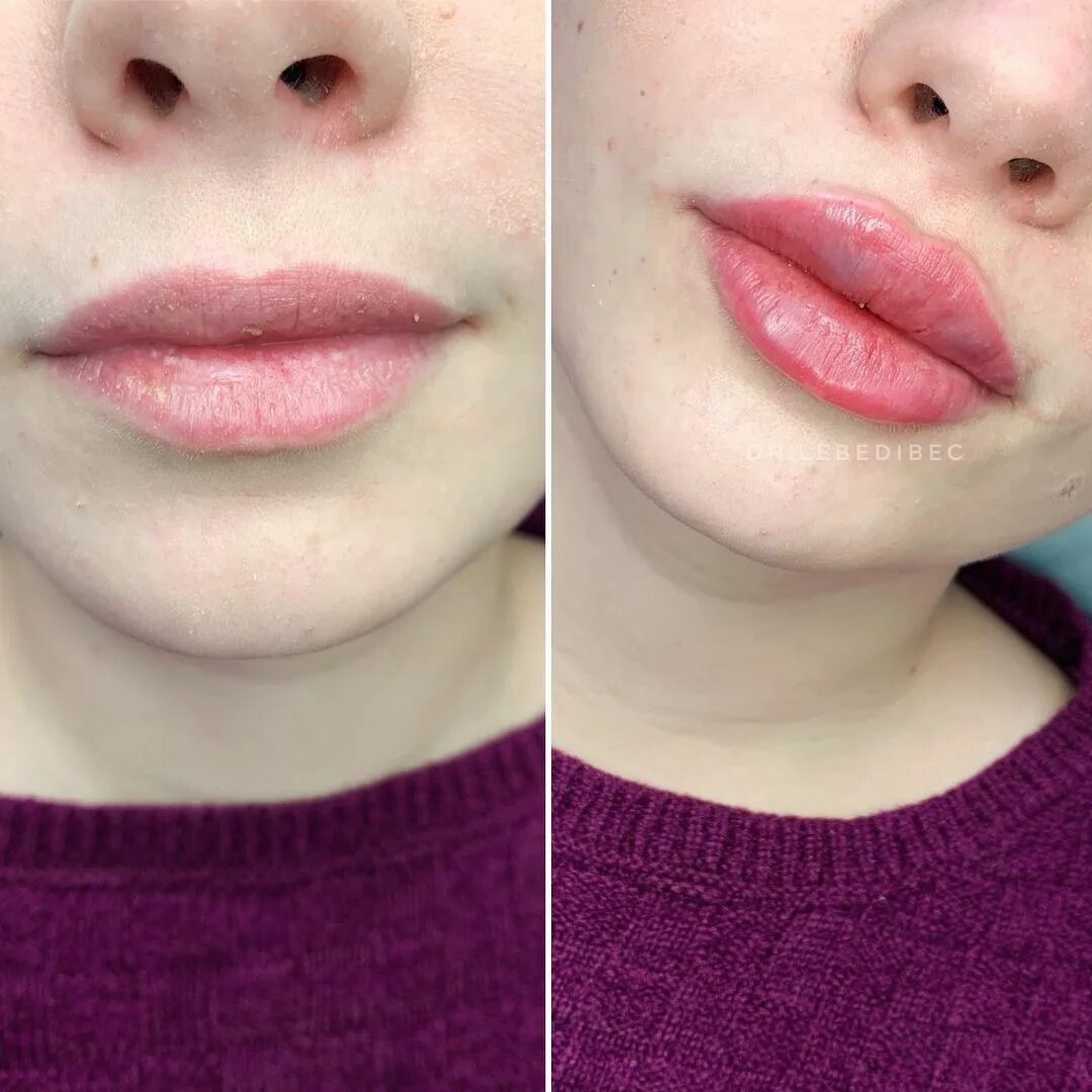 Губы 2 мл. Красивое увеличение губ. Накачивание губ гиалуроновой кислотой 0. Накачивание губ гиалуроновой кислотой 0. Губы 2 мл.