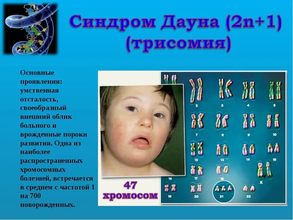 Метод лабораторной диагностики синдрома дауна. Мкб болезнь дауна. Наследственное заболевание дауна. Клинические признаки синдрома дауна. Синдром дауна код.