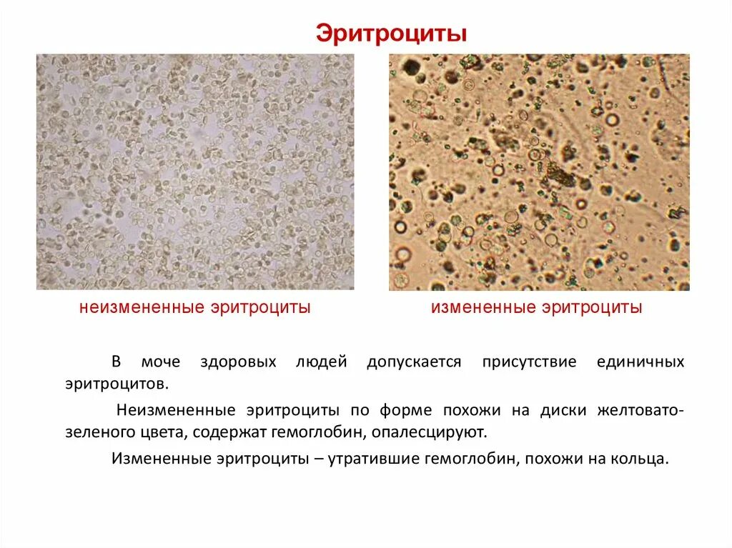 Почему повышены эритроциты в моче. Измененные и неизмененные эритроциты в моче микроскопия. Эритроциты выщелоченные микроскопия. Измененные эритроциты в моче. Изменённые и не изменённые эритроциты в моче.