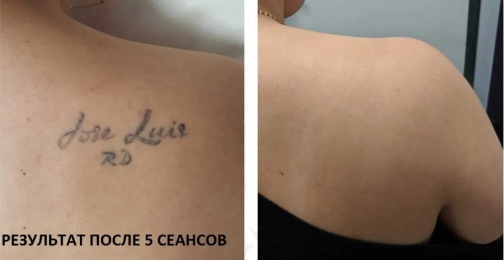 За сколько сеансов сводится татуировка. Этапы сведения татуировки лазером. Первый сеанс тату. Первый сеанс тату. Тату сразу после сеанса.